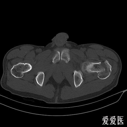 左侧尺骨鹰嘴骨折左侧股骨颈基底及髋臼前缘骨折粗隆间粉碎性骨折