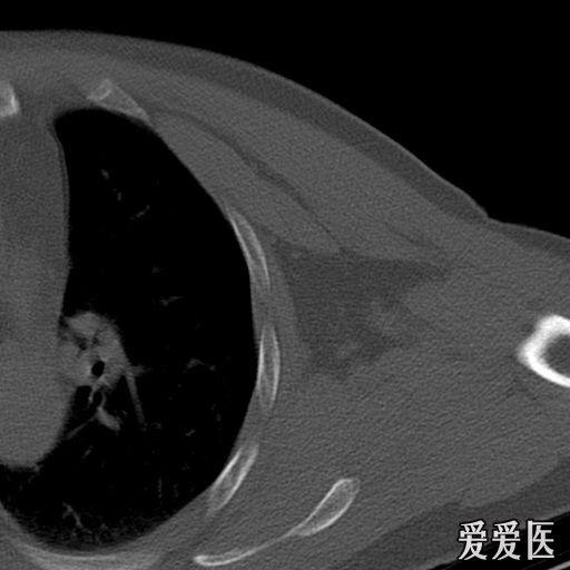 左侧肩胛骨,右侧股骨干骨折