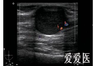 是不是神经鞘瘤? - 第2页 - 超声医学讨论版 - 爱爱医