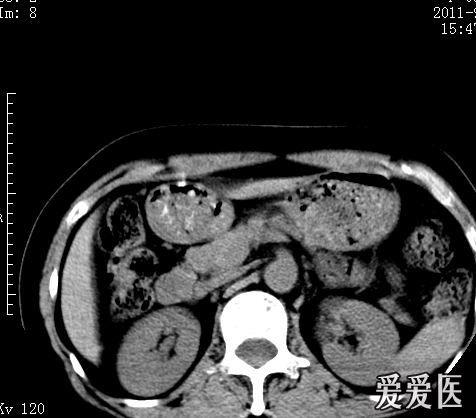 结石静脉石