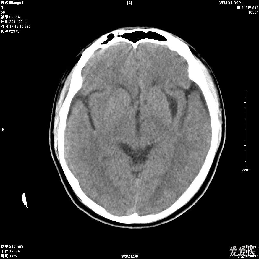 头颅ct平扫大脑中动脉密度增高两例