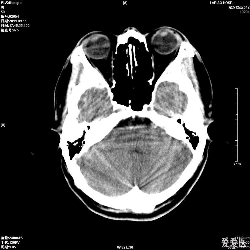 头颅ct平扫大脑中动脉密度增高两例