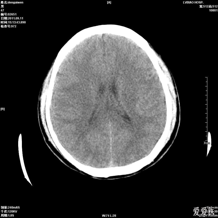 头颅ct平扫大脑中动脉密度增高两例