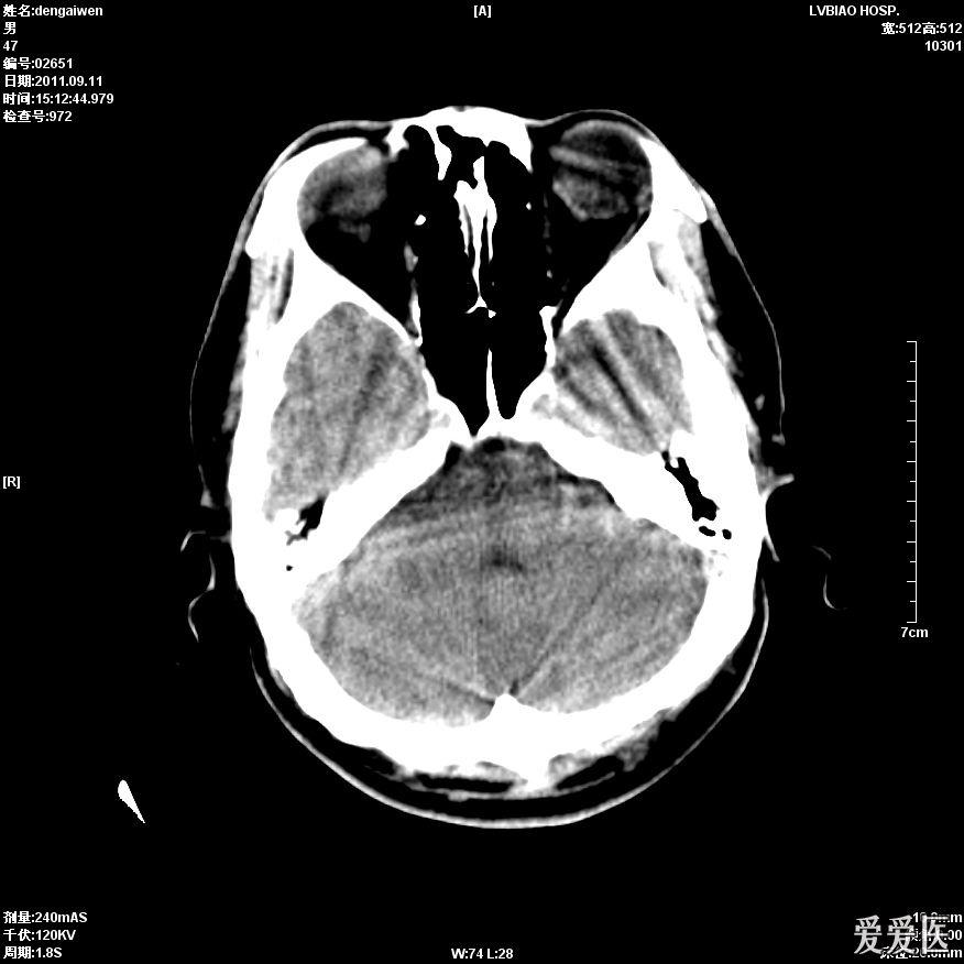 头颅ct平扫大脑中动脉密度增高两例