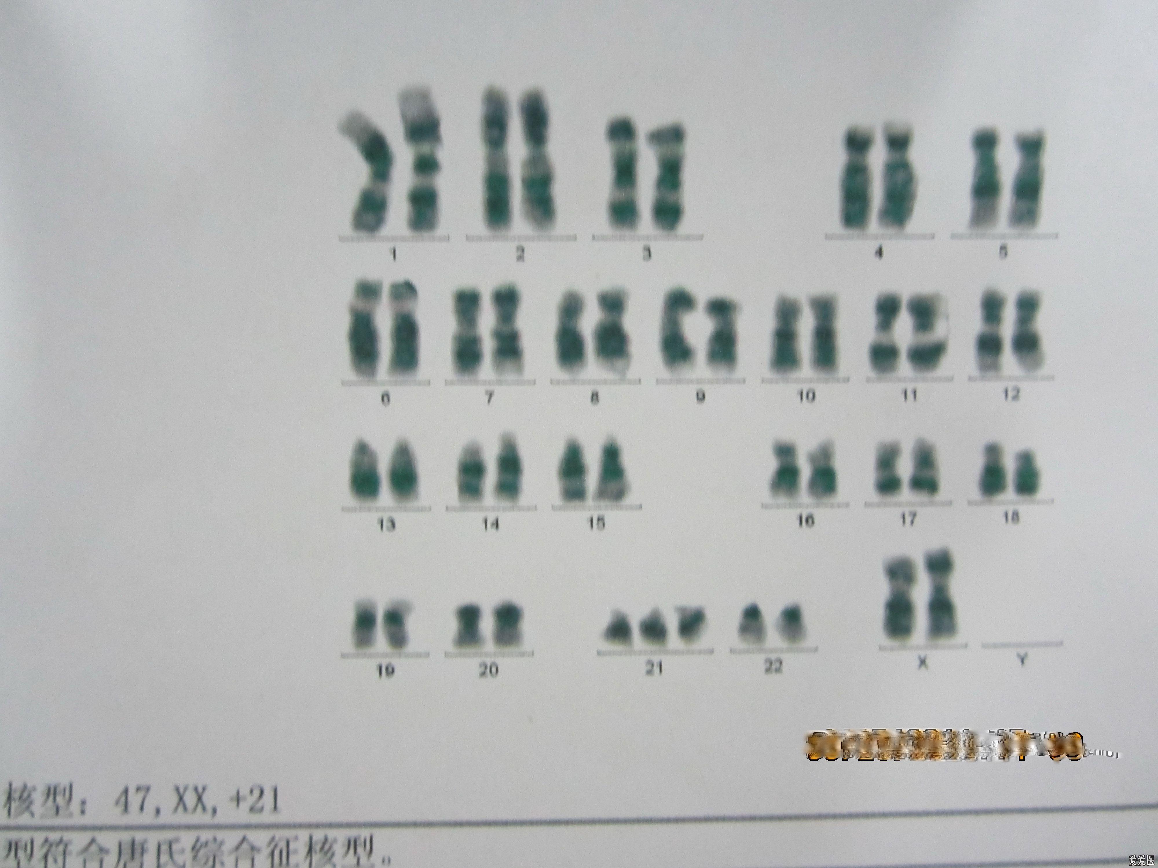 一起学习21—三体综合征