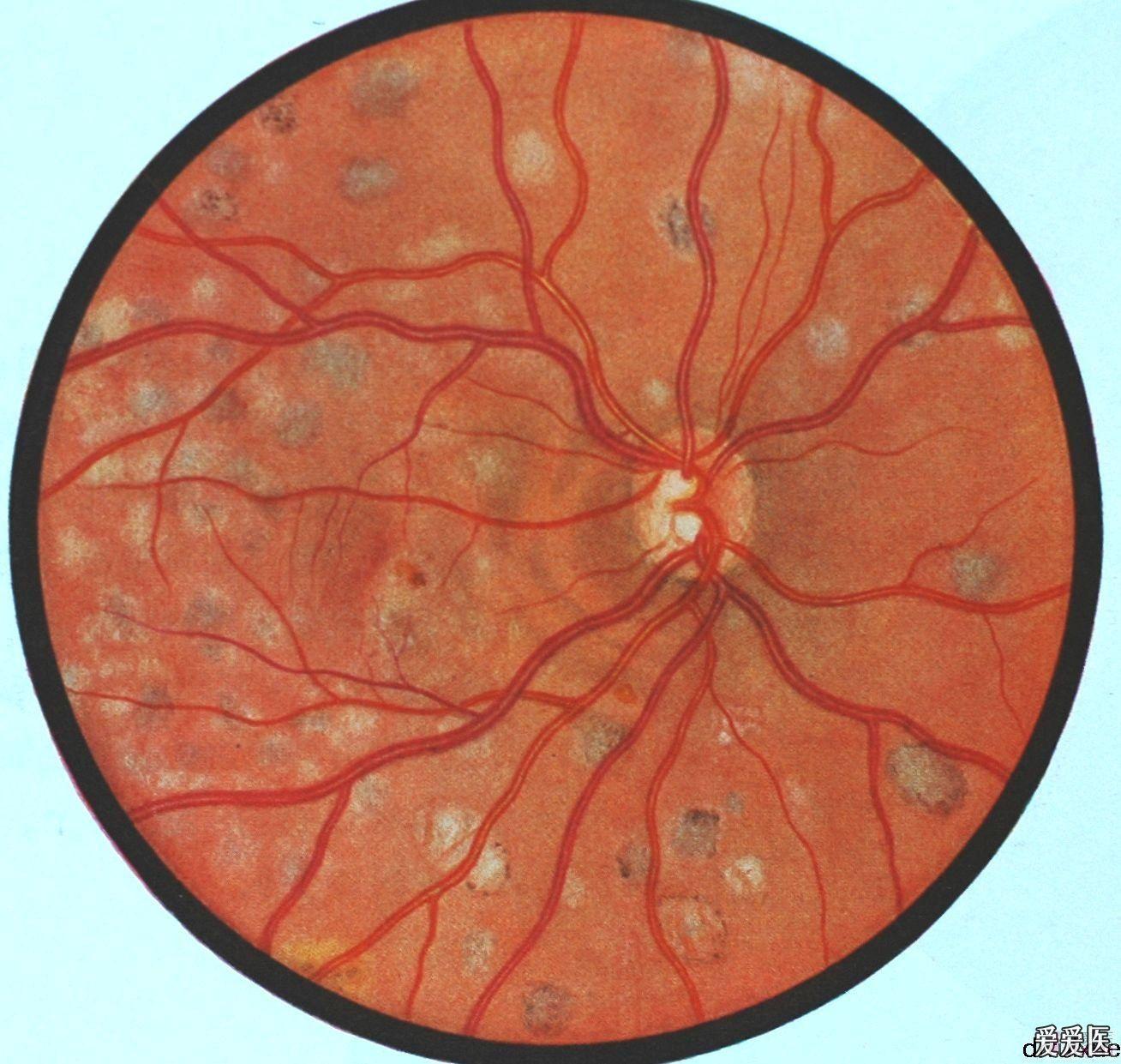 15结核性播散性脉络膜视网膜炎(退性期).jpg