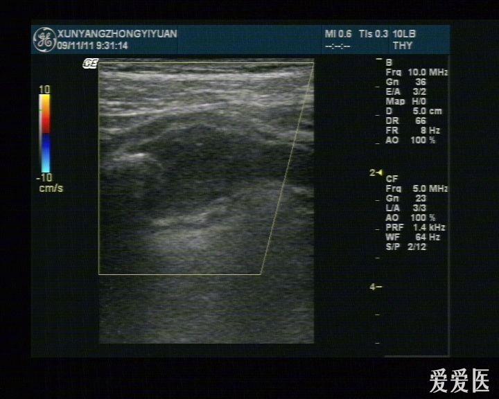 阑尾炎并粪石 超声医学讨论版 爱爱医医学论坛