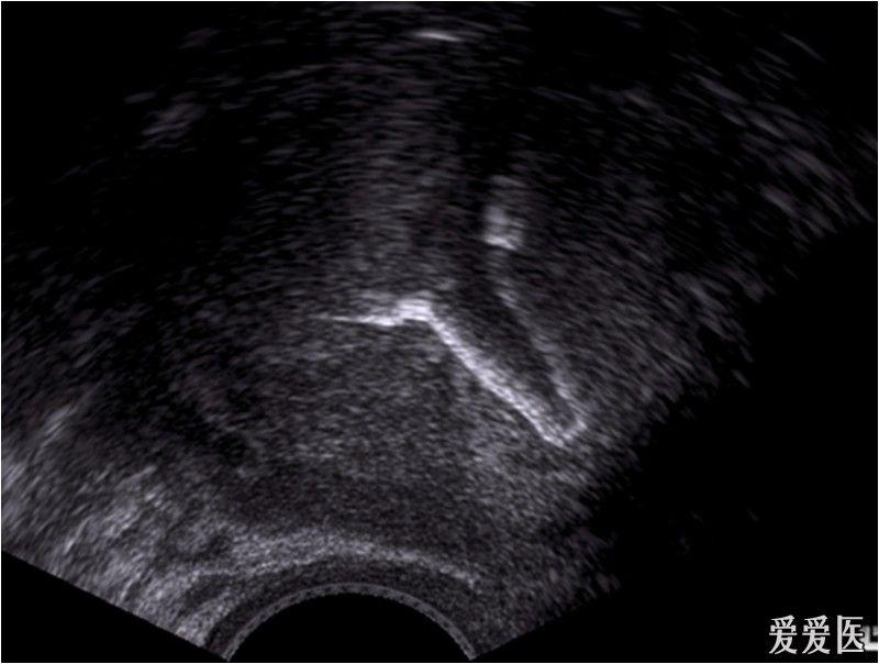 爱母环在超声中的图像显示