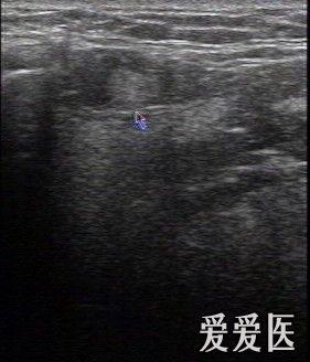 双侧颌下淋巴结肿大
