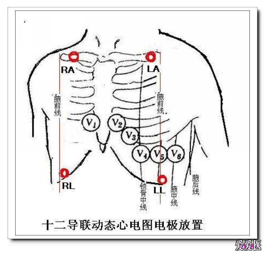 动态心电图不可能像常规心电图那样安装肢导联电极.