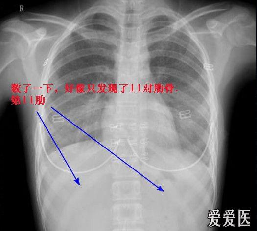 数了一下,好像只发现了11对肋骨,第12未看到