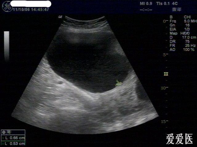左侧附件包块粘液性囊腺癌