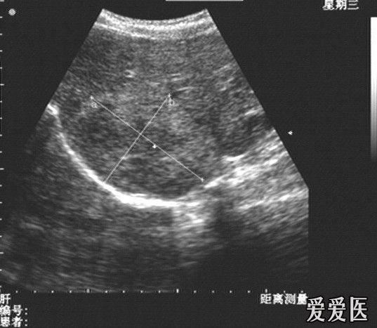 ct诊断肝血管瘤,超声呢?