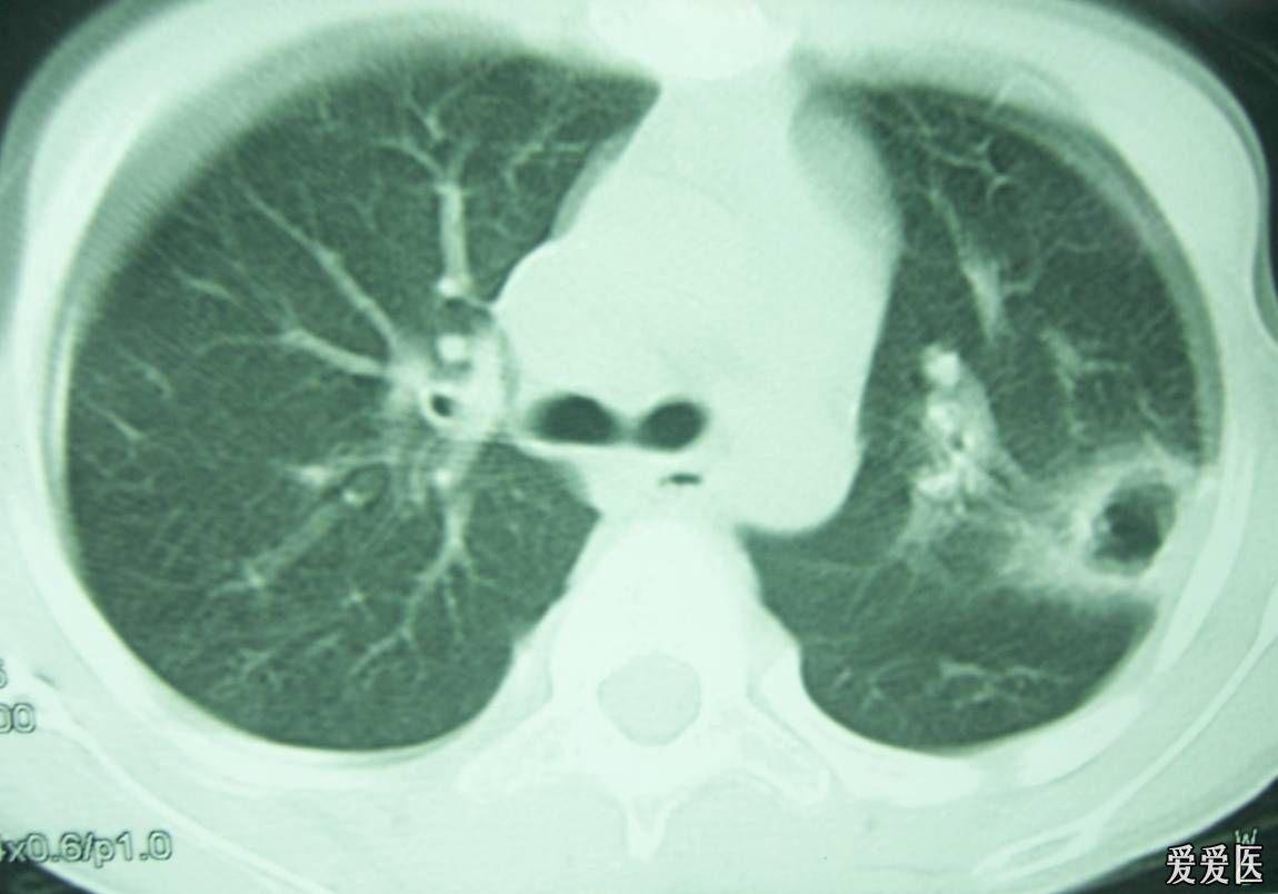 [看图说话]3张x线片诊断(肺脓肿)