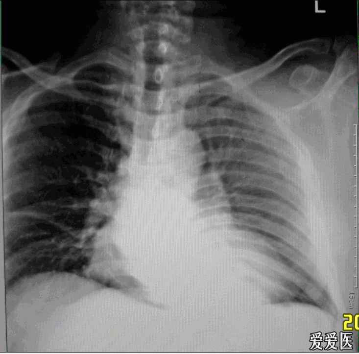 注册x  病人为59岁男性,小儿麻痹症 双下肢发育不良,胸廓畸形,现诉