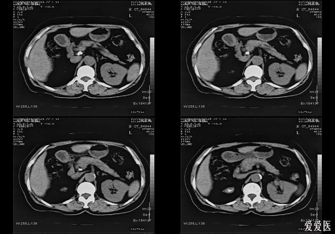 分享一例肾自截病例ct平扫