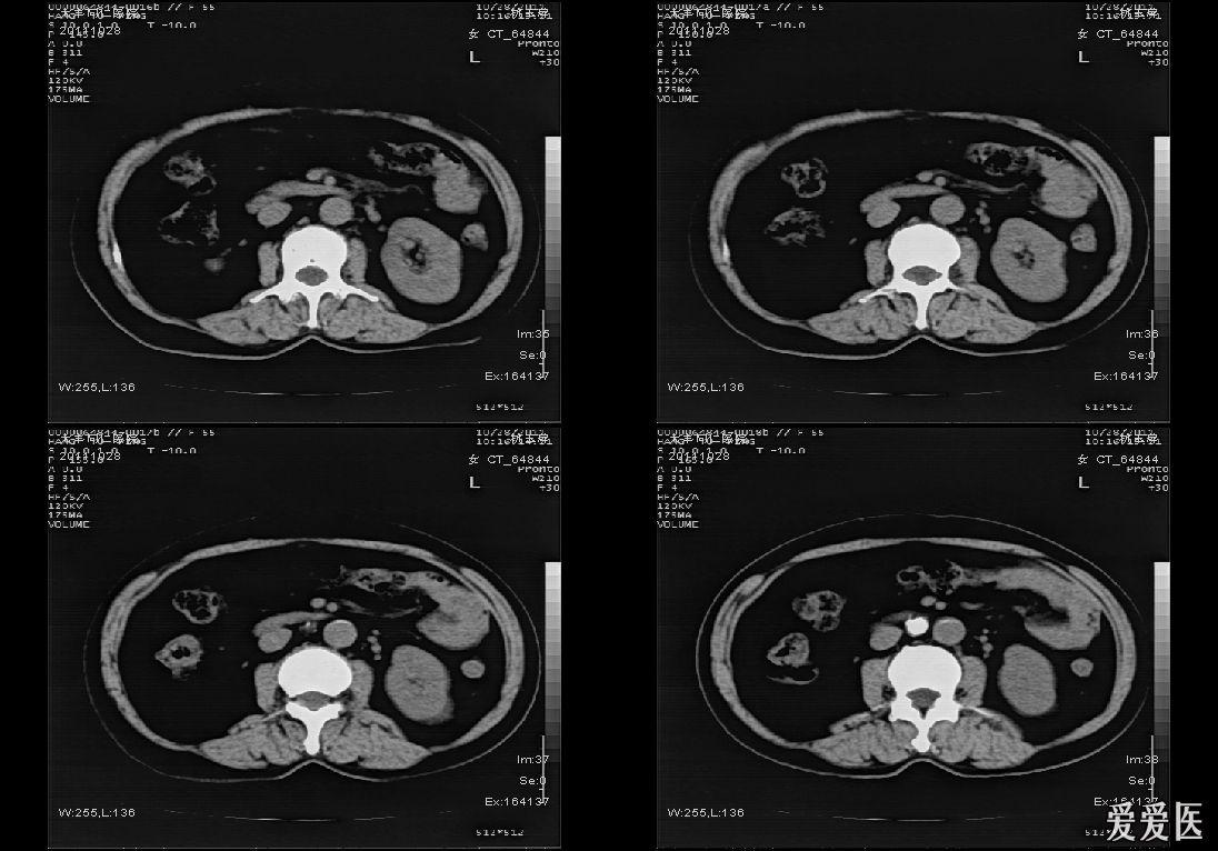 分享一例肾自截病例ct平扫
