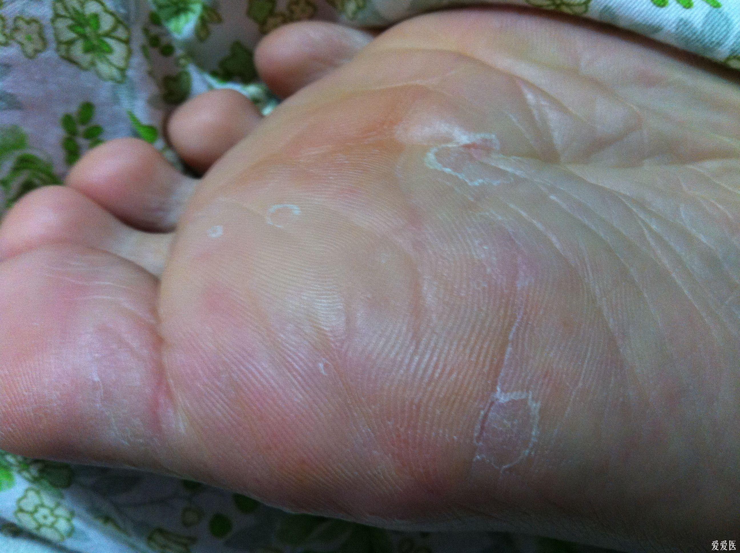 请问这是脚癣还是湿疹或者其他的(基层小医生求教)