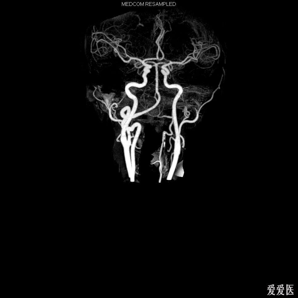 颈部血管造影病例