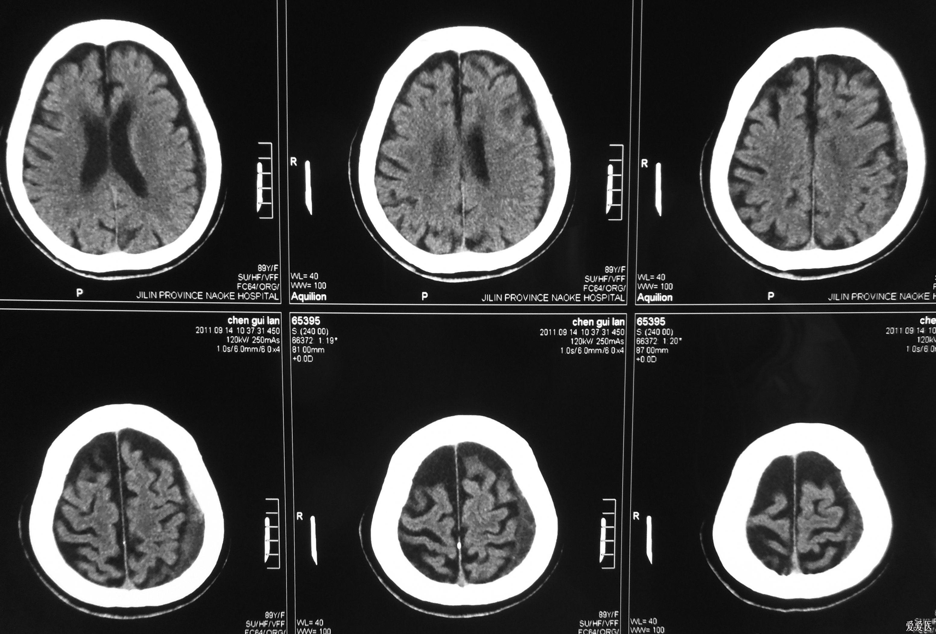 女患89岁阵发性tia发作头部ctmri