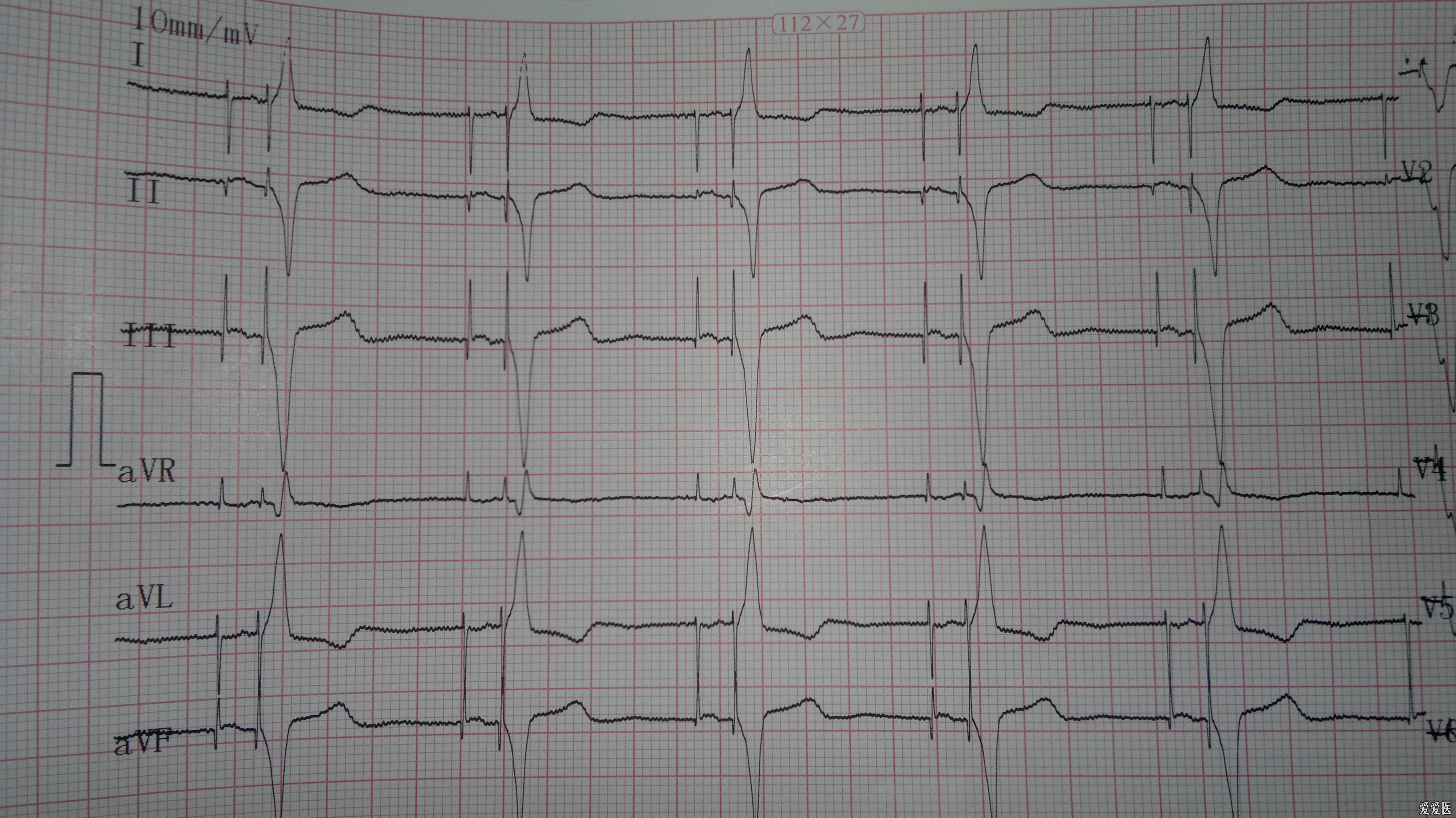 装过起搏器的心电图