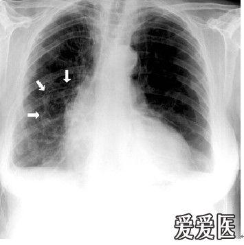 69 呼吸版经验交流(7)气胸:影像学解读指南   这张胸片显示了肺大疱