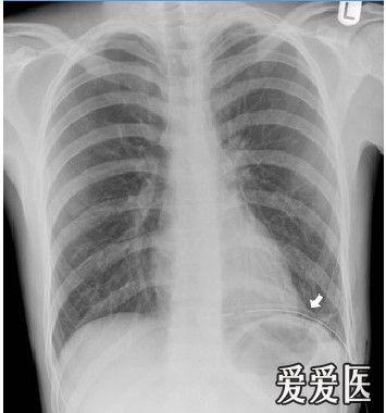 呼吸版经验交流(7)气胸:影像学解读指南