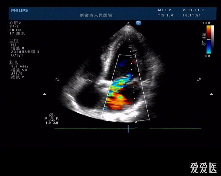 今天做了个典型病例----腱索断裂