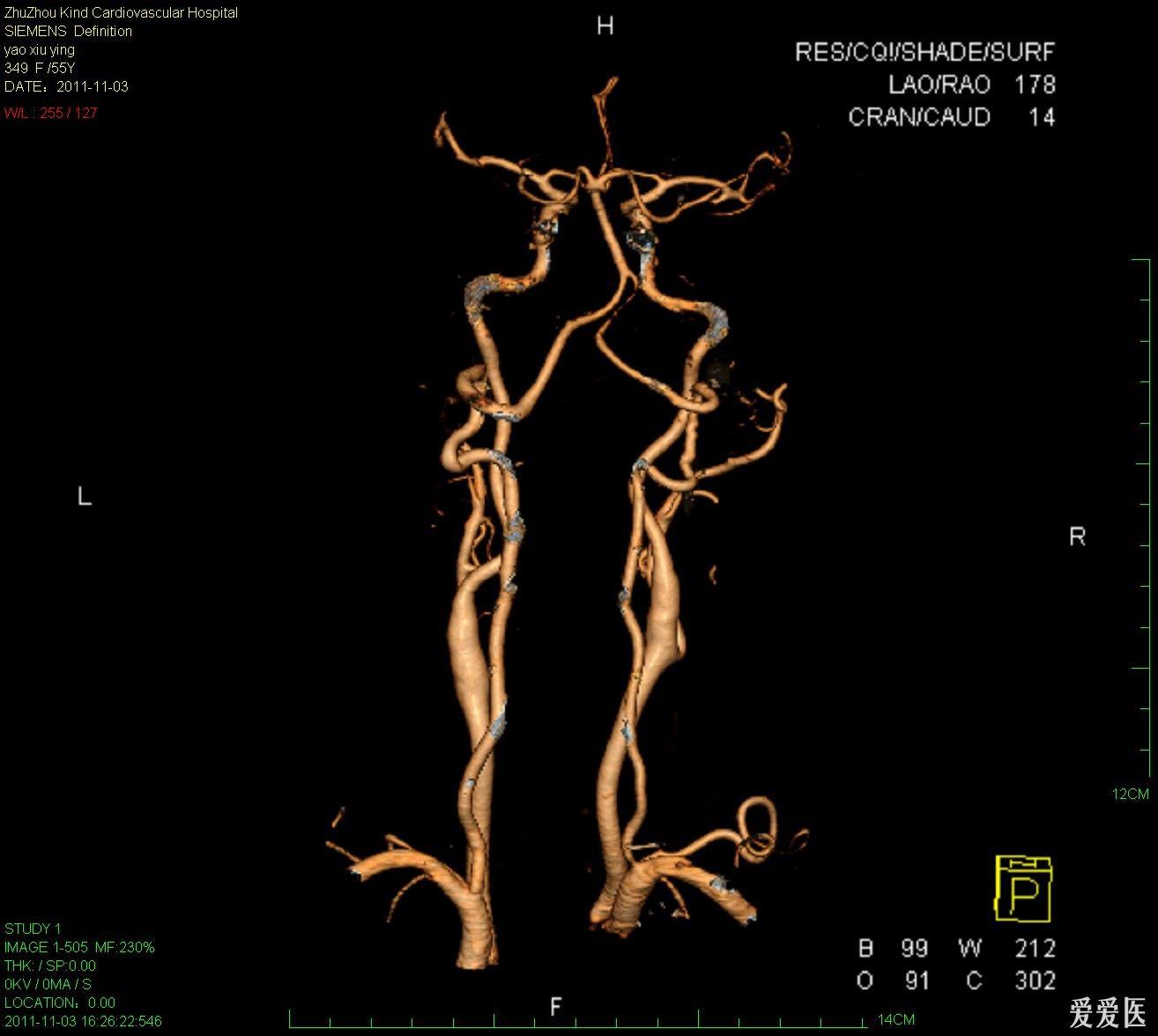 双源ct头部血管cta - 医学影像学讨论版 - 爱爱医医学