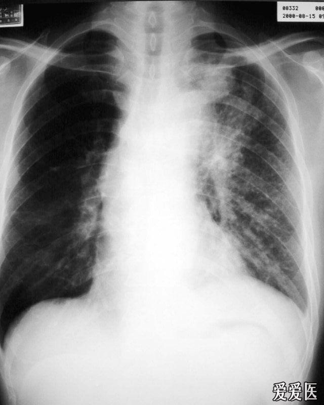 一组播散型肺结核图片鉴赏 医学影像学讨论版 爱爱医医学论坛