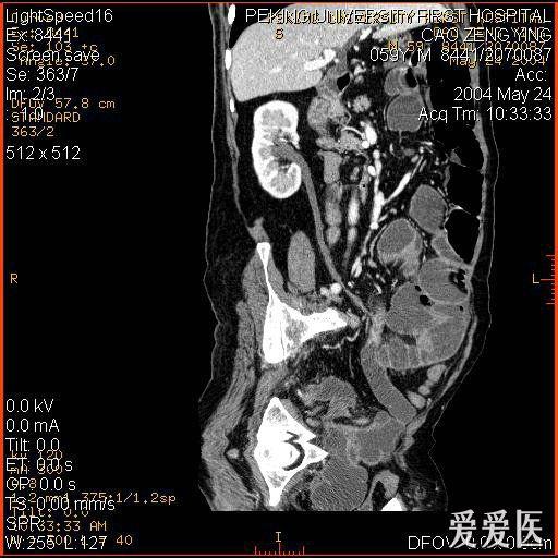 肠梗阻ct图片鉴赏