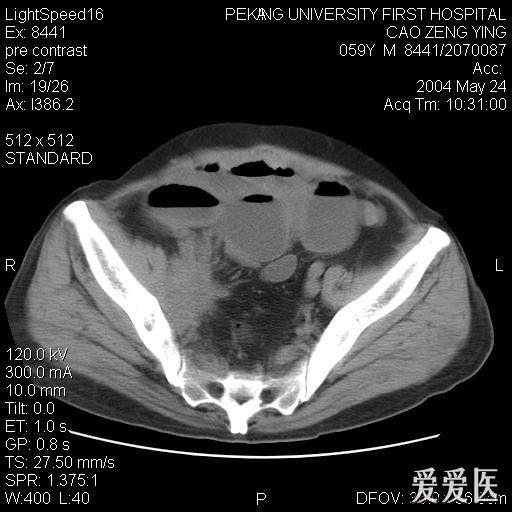 肠梗阻ct图片鉴赏