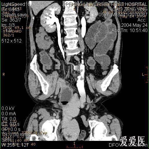 肠梗阻ct图片鉴赏 - 医学影像学讨论版 - 爱爱医医学