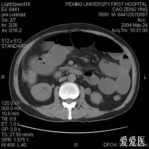 肠梗阻ct图片鉴赏