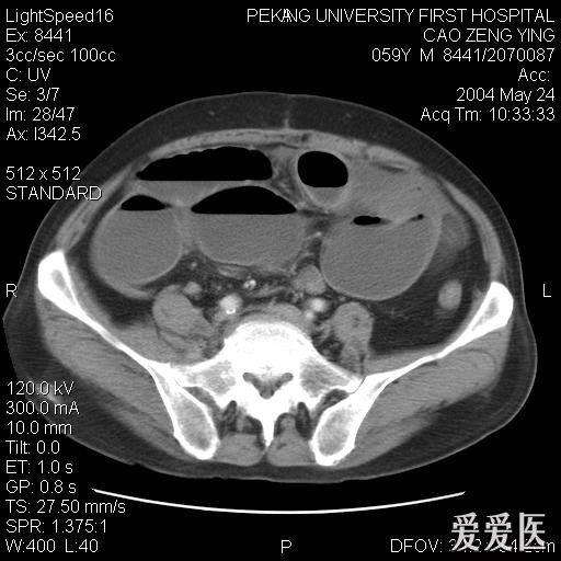 肠梗阻ct图片鉴赏