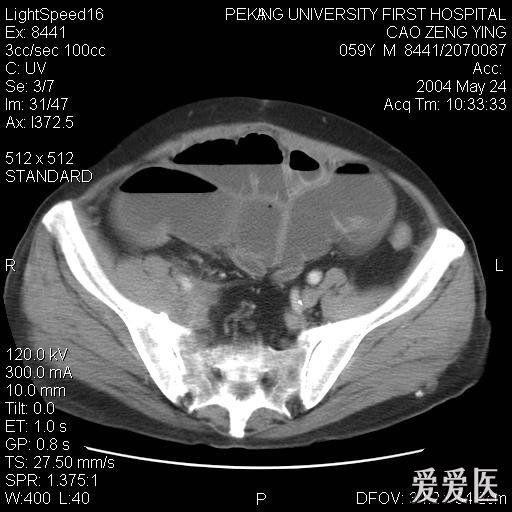 肠梗阻ct图片鉴赏 - 医学影像学讨论版 - 爱爱医医学