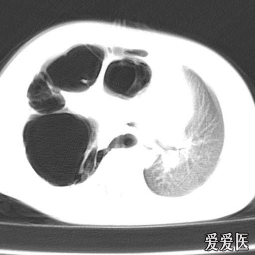 看图说话可能是什么病支气管胸膜瘘