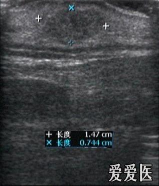 (病理结果:钙化上皮瘤 超声医学讨论版 爱爱医医学论坛