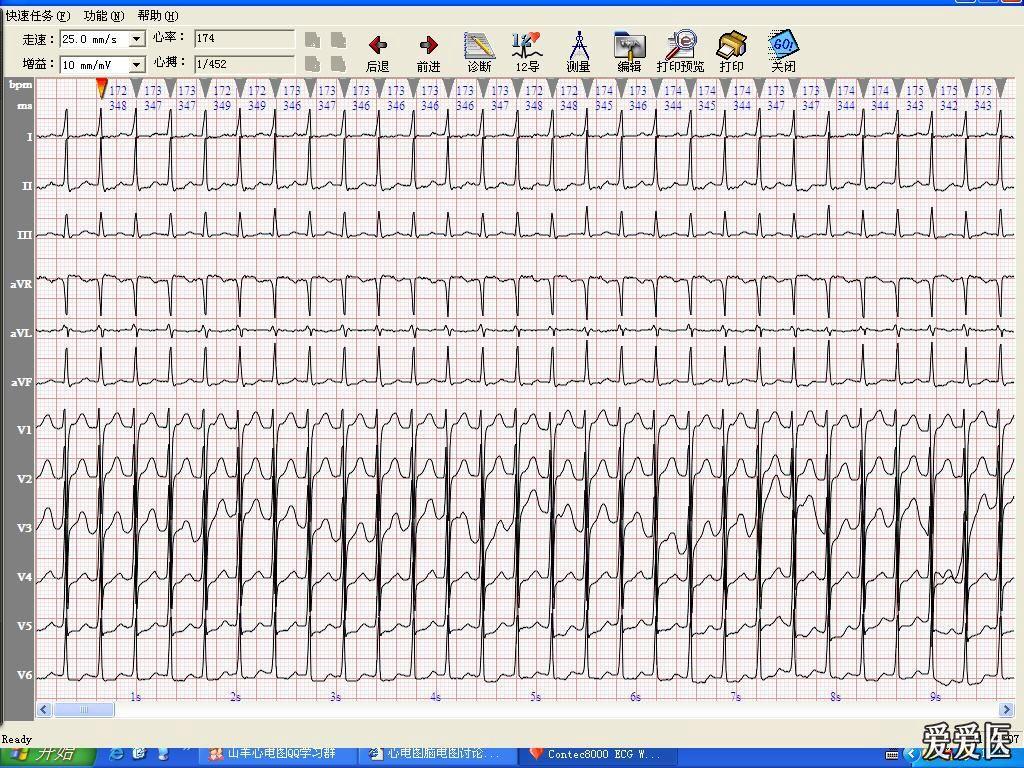 心电图讨论2