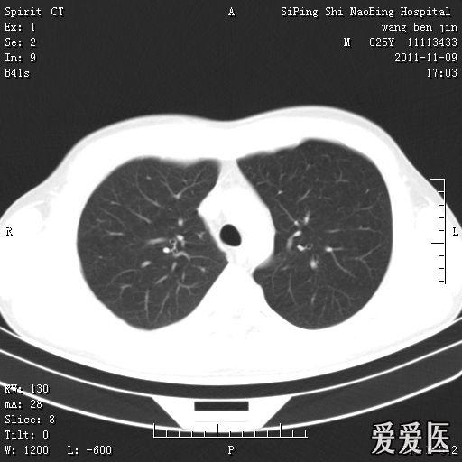 男性患者25岁,无明显临床症状,肺部ct