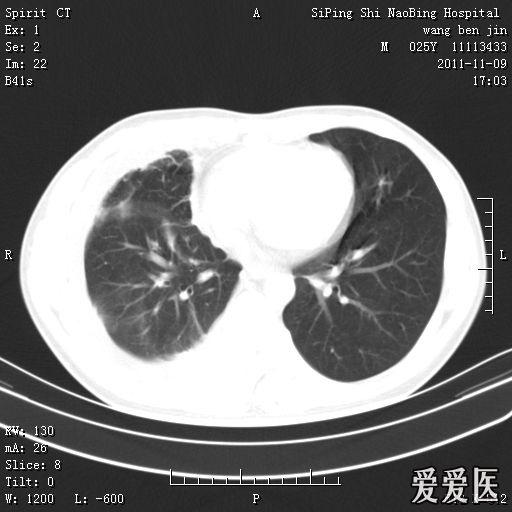 三个月前患者被诊断为结核性胸膜炎,当时抽出胸水2000ml,为淡黄色.