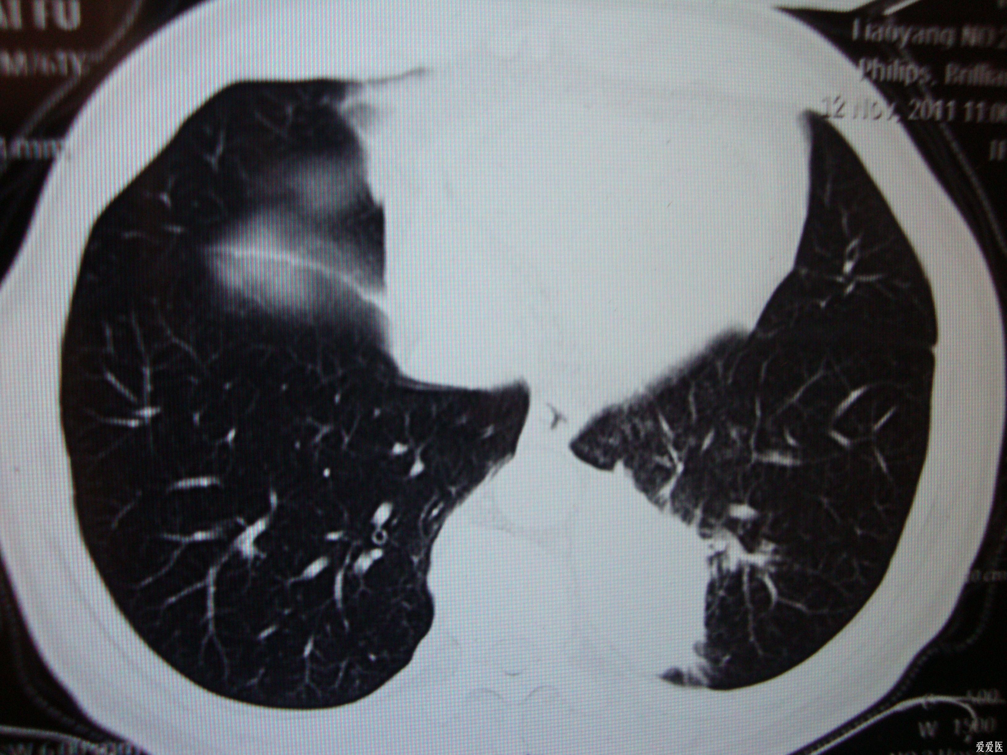请各老师给看一看肺ct