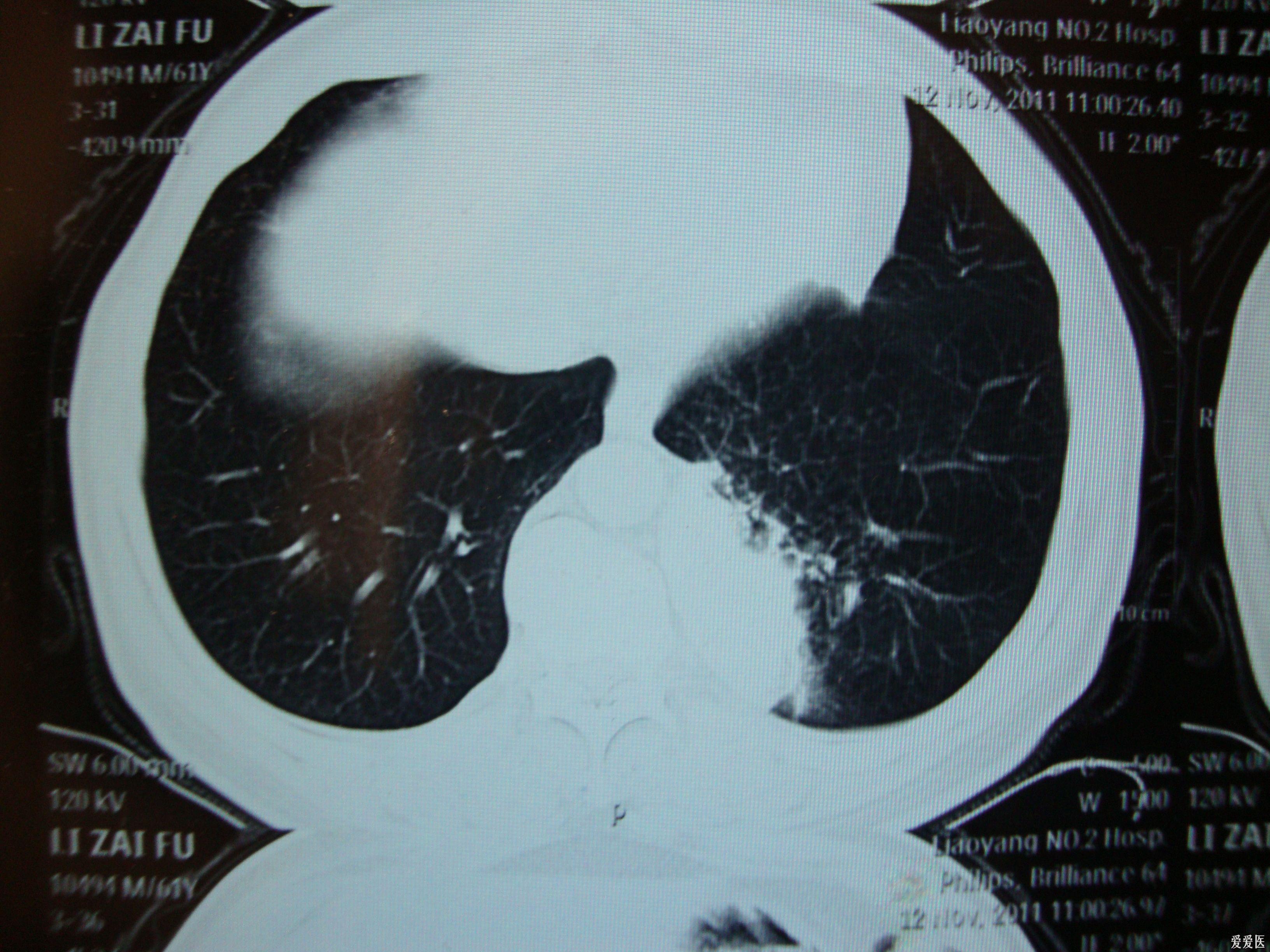 请各老师给看一看肺ct