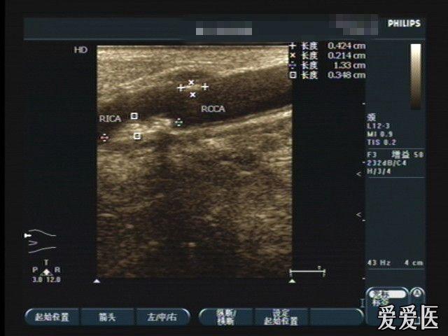 颈动脉粥样斑块形成并狭窄. - 超声医学讨论版 - 爱爱