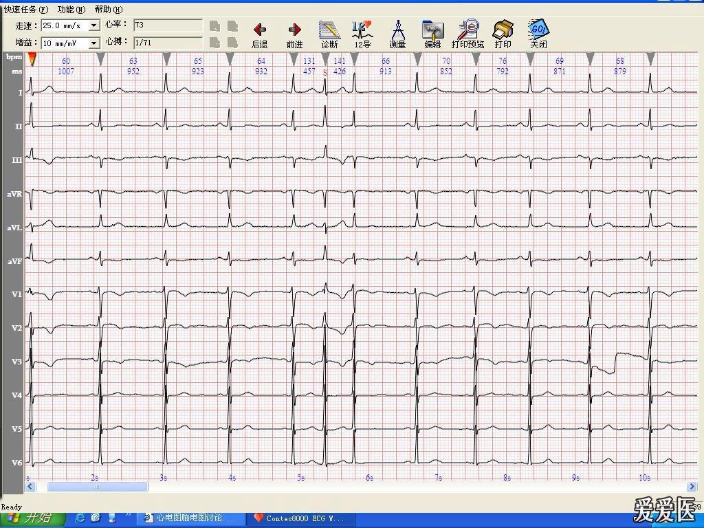 心律失常分析-女性患者体检心电图