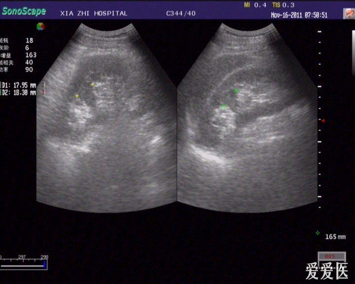 没见过肾柱肥大这幅是吗请高手指点