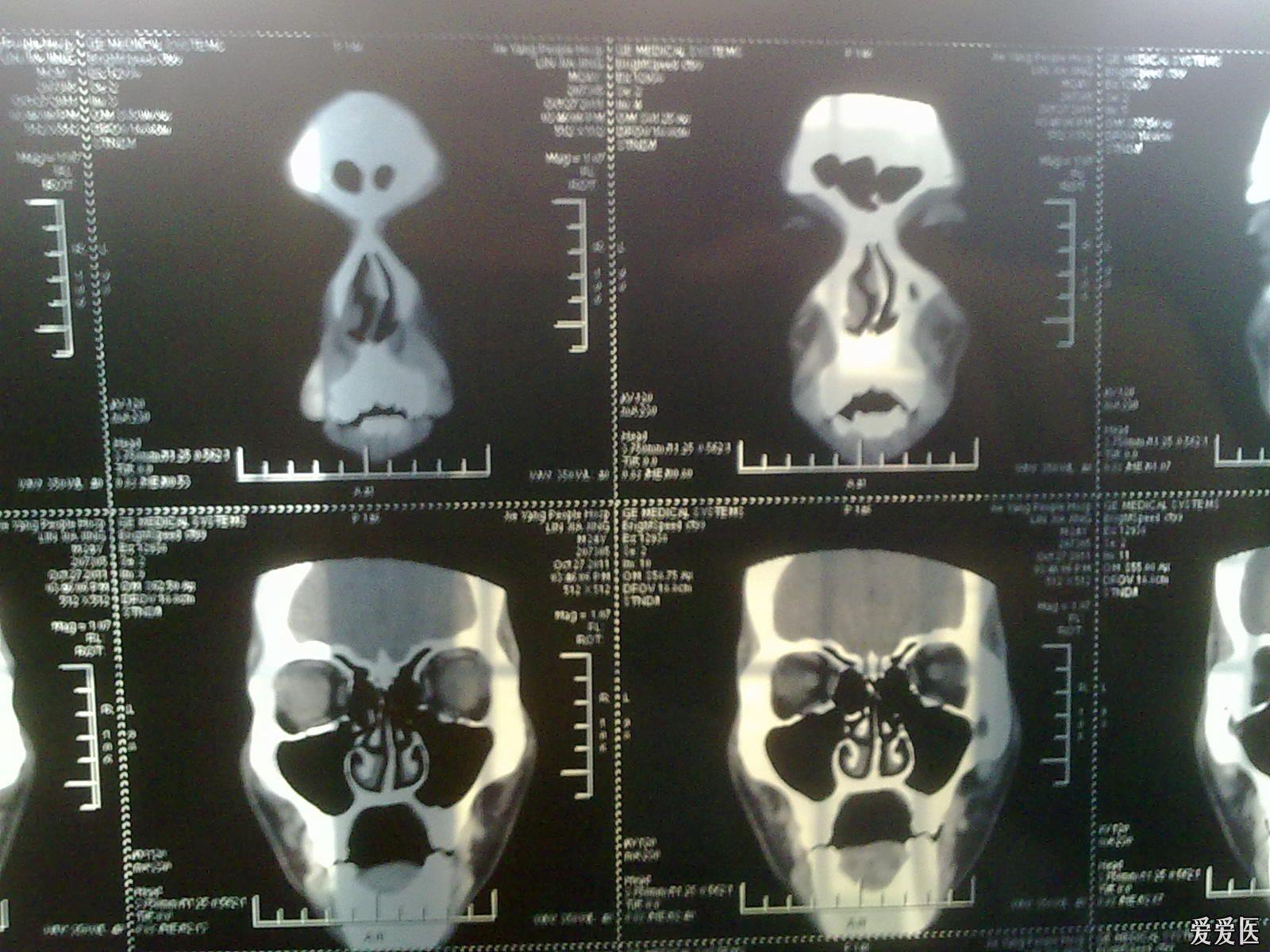 求助!麻烦专业医生人士帮我分析这病人的鼻部ct