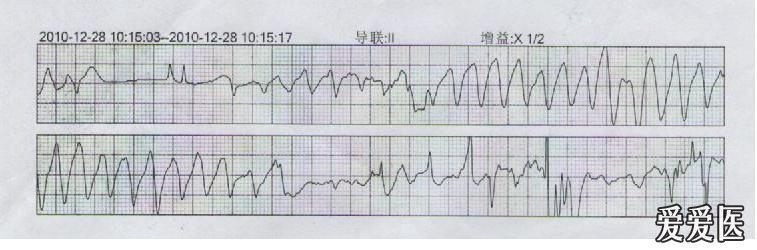 胺碘酮致尖端扭转型室性心动过速一例(有图有真相~~)
