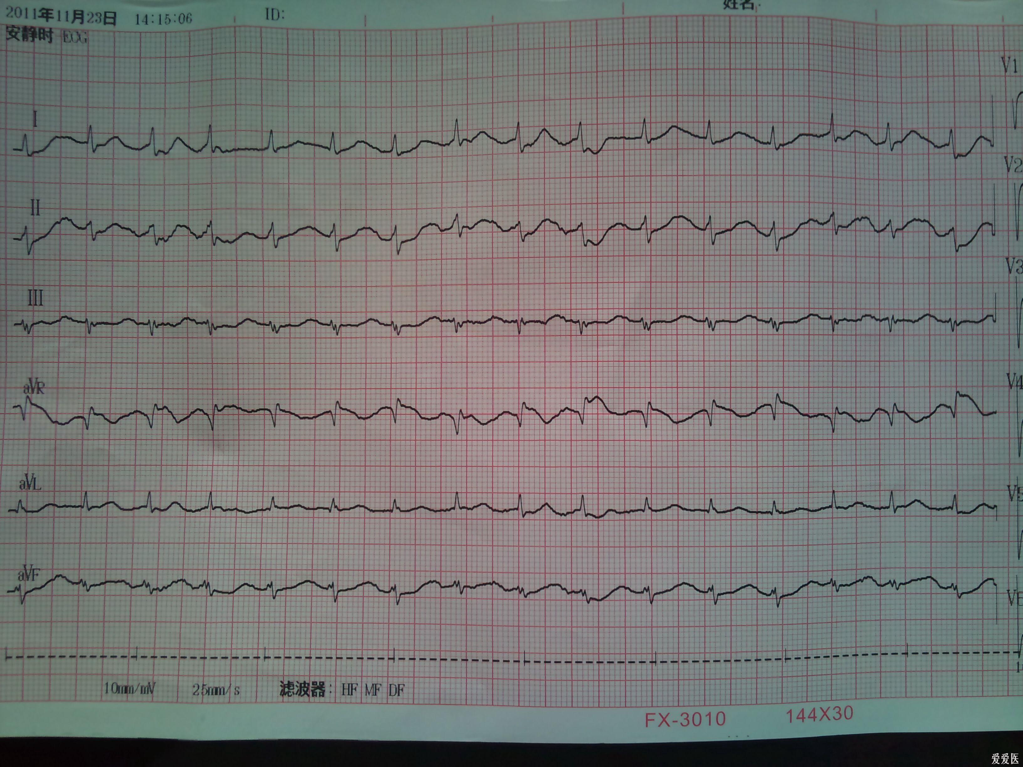 这个是房速还是窦速 心电图脑电图专业讨论版 爱爱医医学论坛
