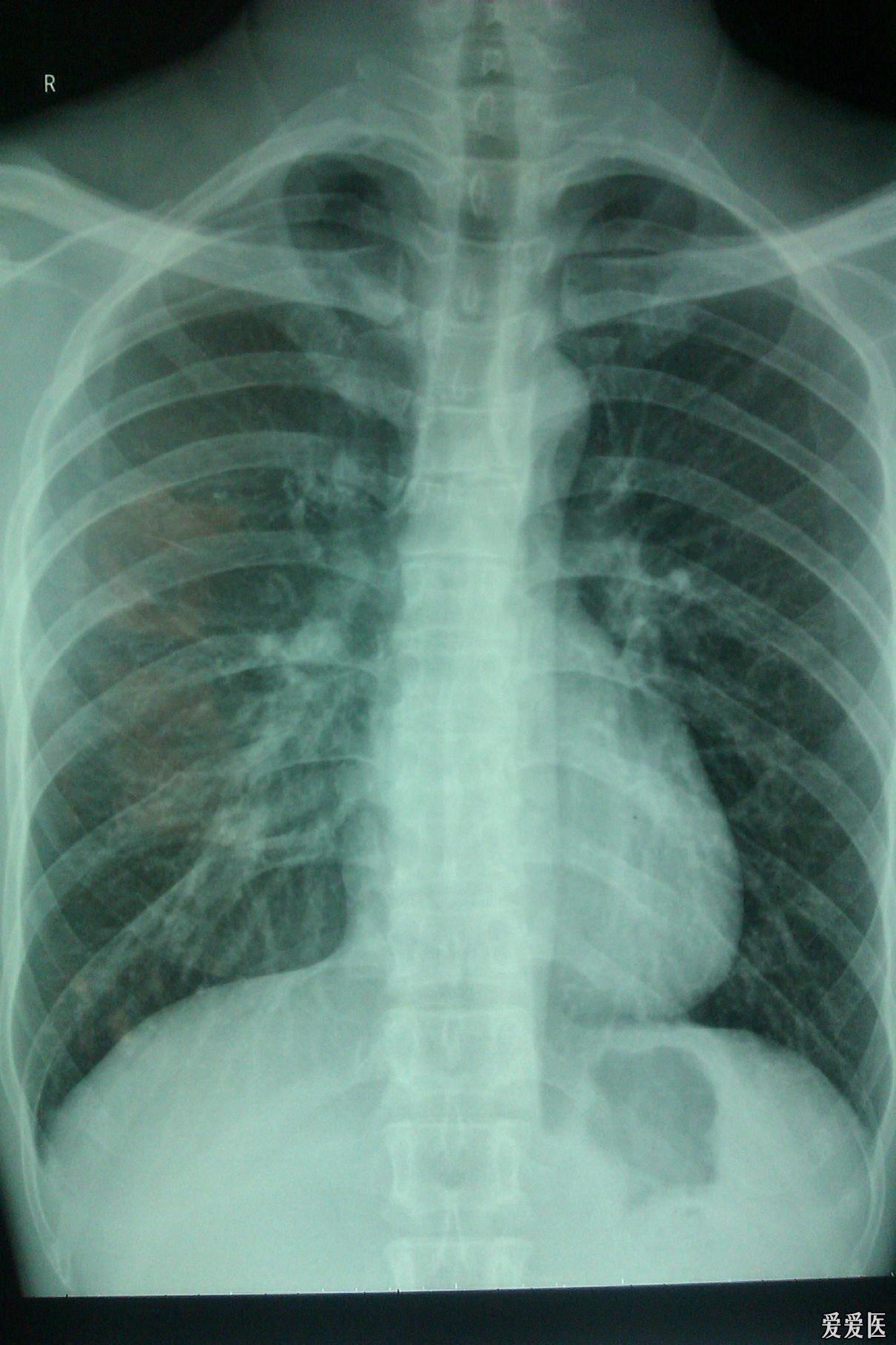 胸片肺部感染结核